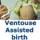 ventouse assisted birth